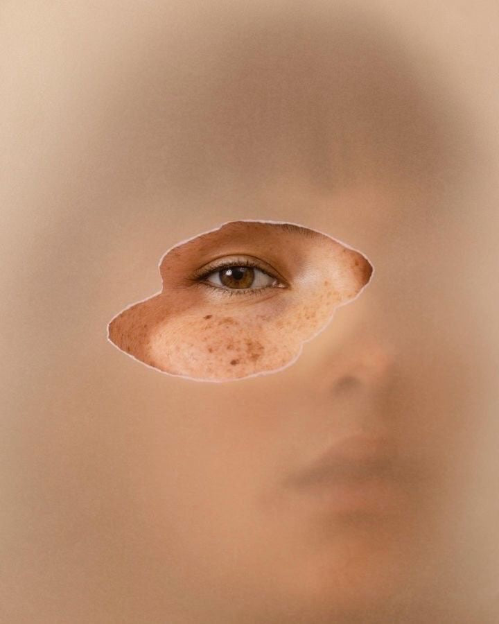 Dark spots & Uneven Skintone